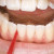 Cara Menghilangkan Karang Gigi Mudah Alami