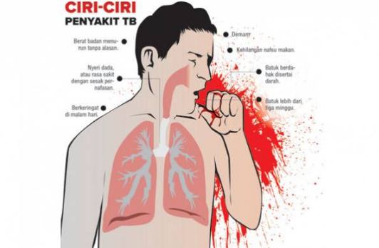 Gejala Penyakit TBC dan Penyebabnya